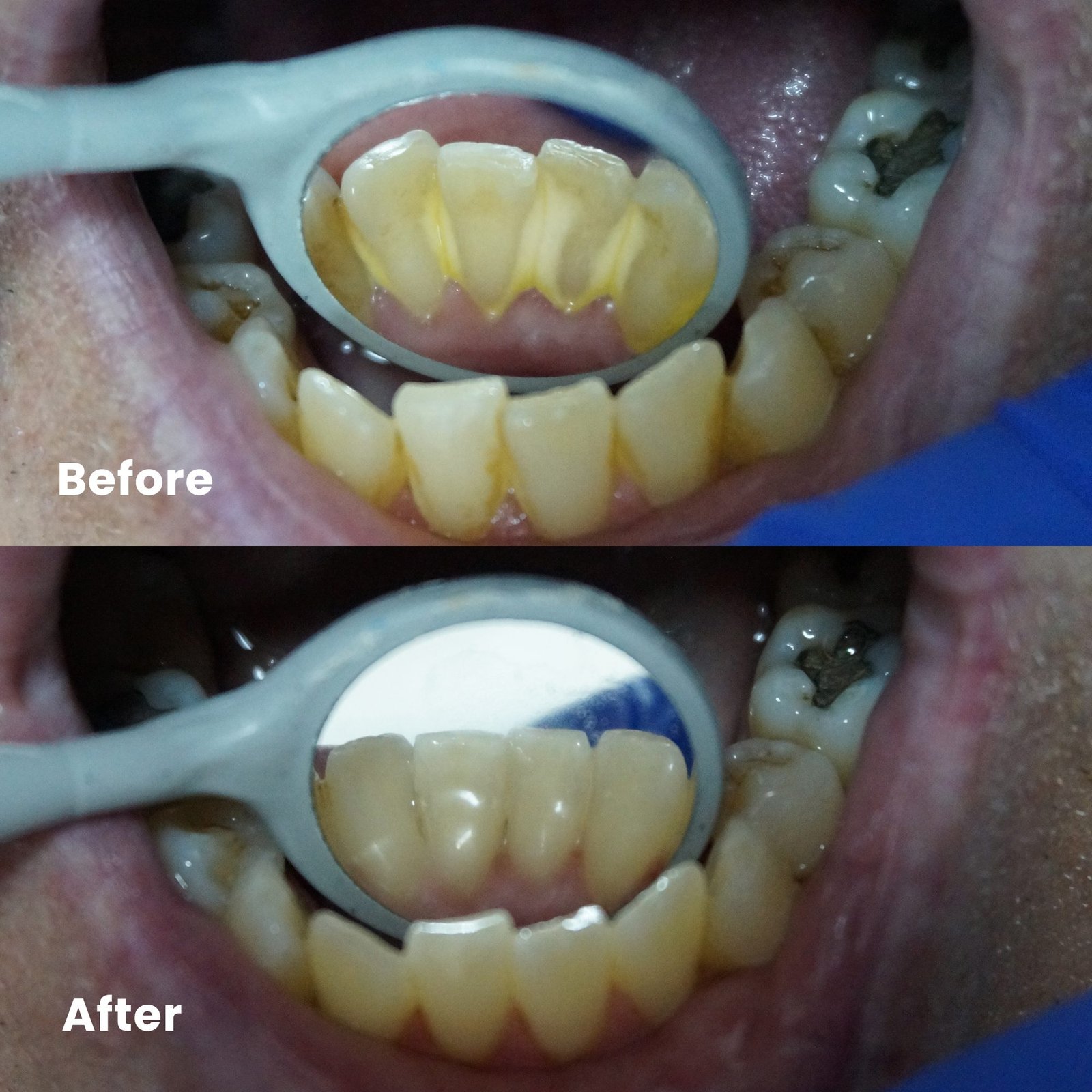 Healthy smile after professional dental cleaning in PCMC