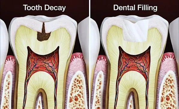High-quality filling materials used by expert dentist