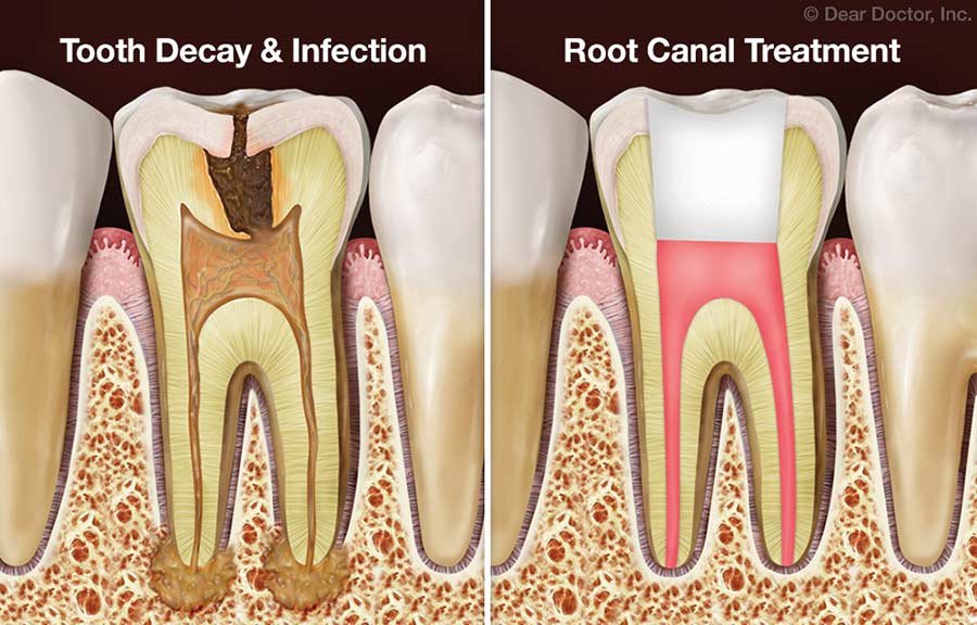 Digital X-ray showing infected tooth root requiring RCT