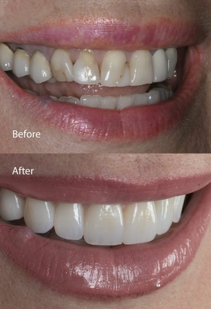 Damaged tooth restored with dental cap