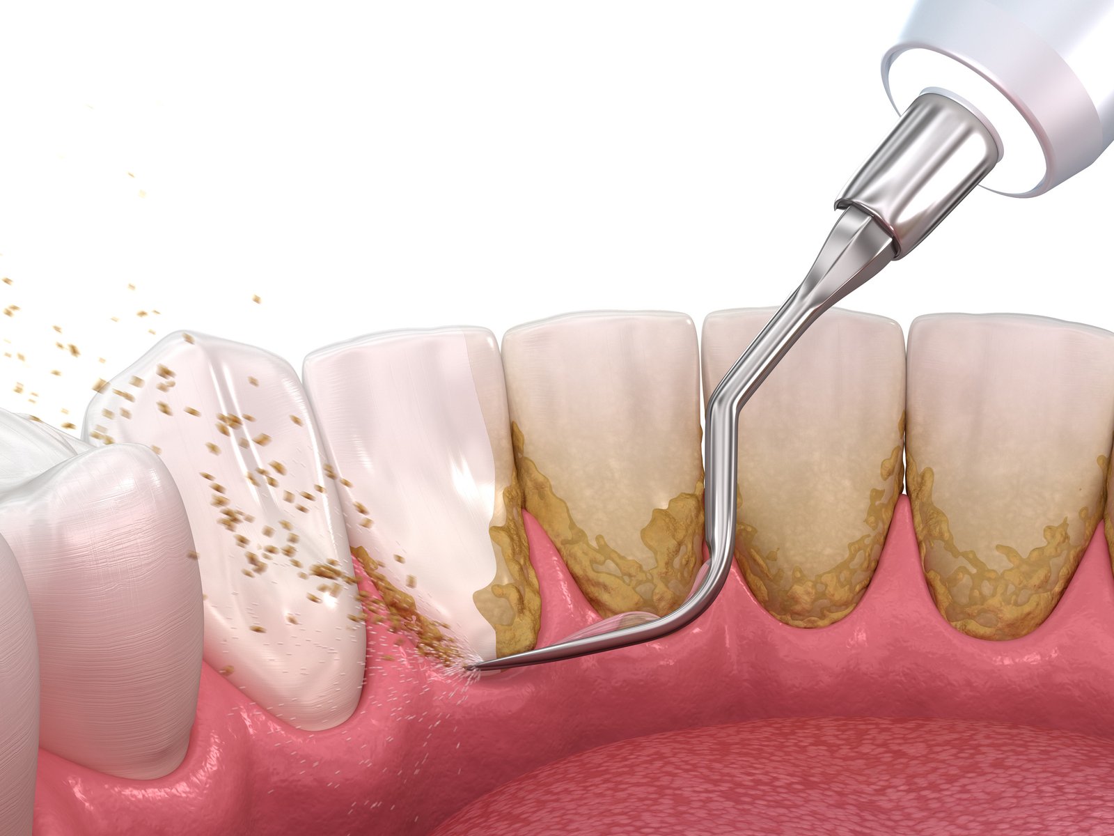 Ultrasonic teeth scaling to remove tartar buildup
