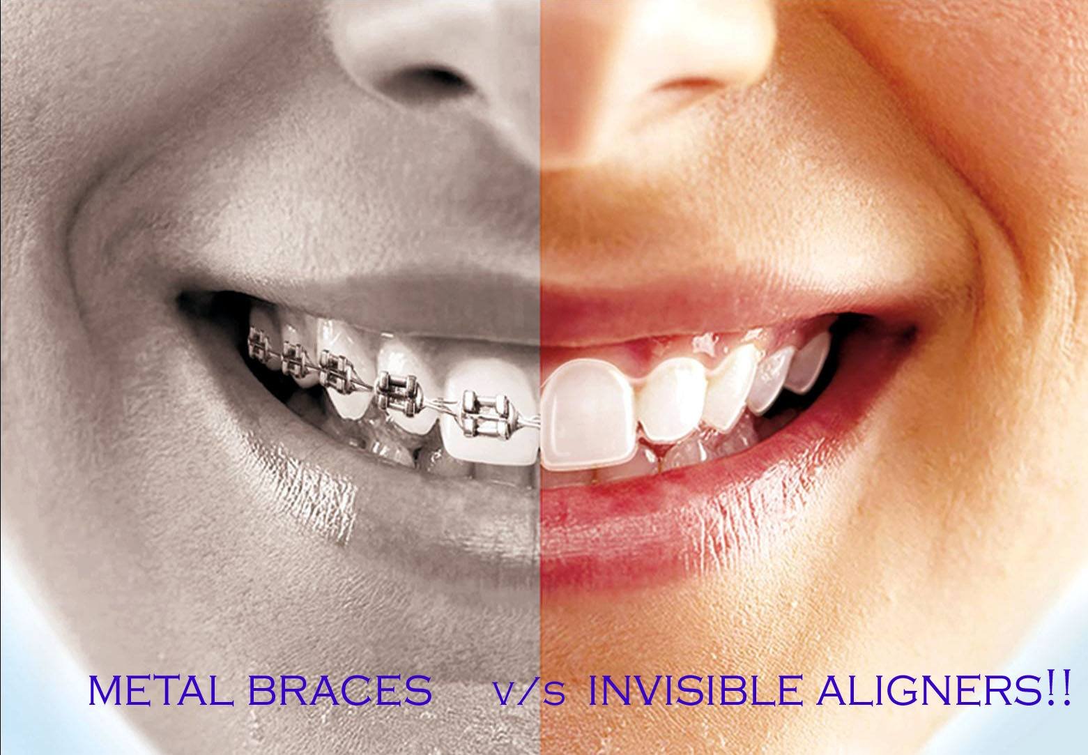 Metal braces treatment in Pimple Gurav for teeth alignment