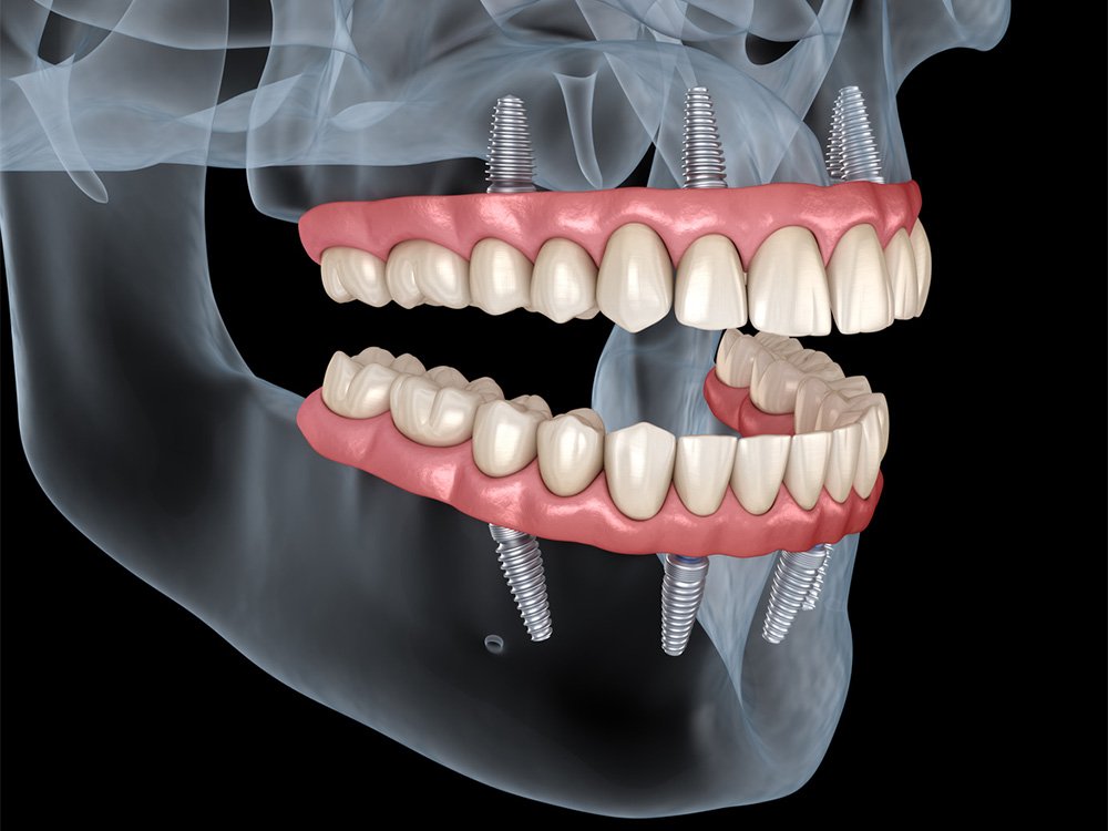 Post-implant X-ray after tooth restoration in PCMC