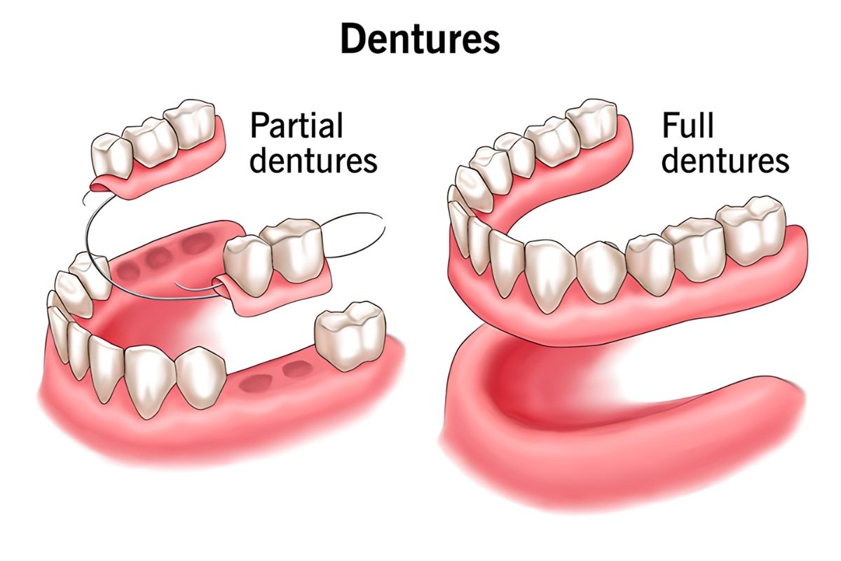 Full and partial dentures for missing teeth replacement