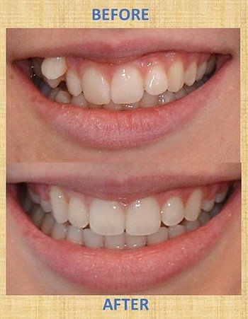 Impacted wisdom tooth requiring extraction