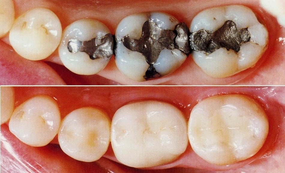 Cavity restored with composite filling – Before After Result
