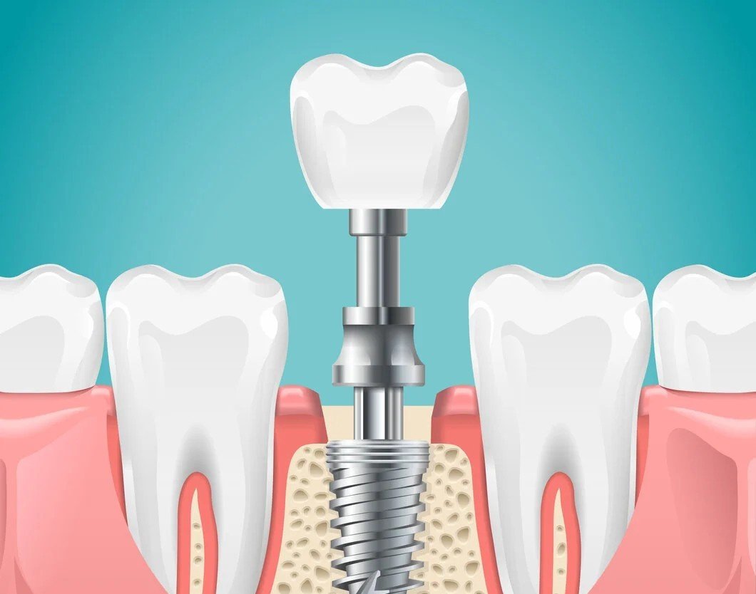 Sterile implant surgery environment at Tooth Care Clinic