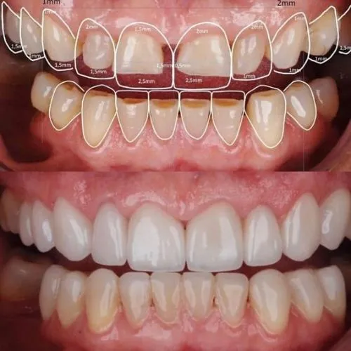 Patient smiling after smile design in PCMC Pune