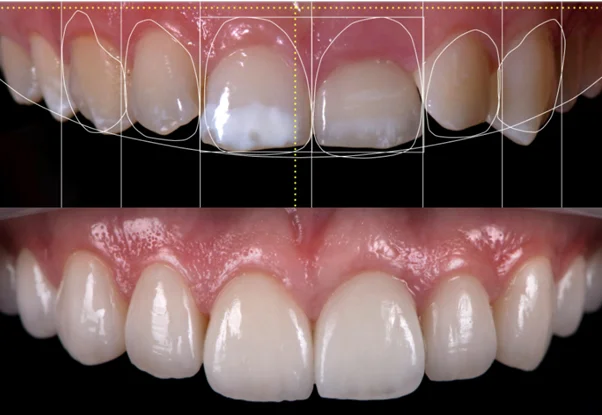 Digital smile design preview before treatment
