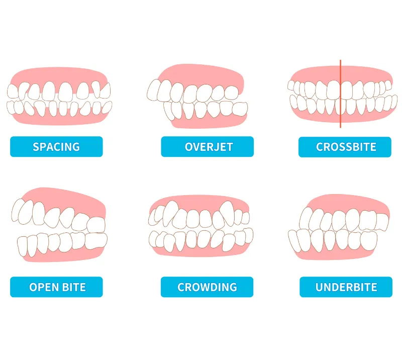 Metal braces treatment in Pimple Gurav for teeth alignment