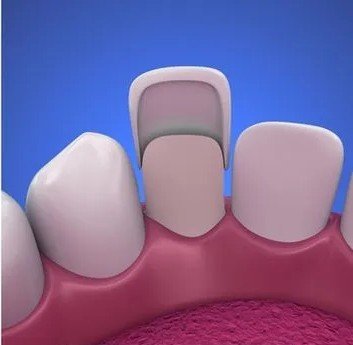 Selecting veneer shade for natural-looking teeth in PCMC