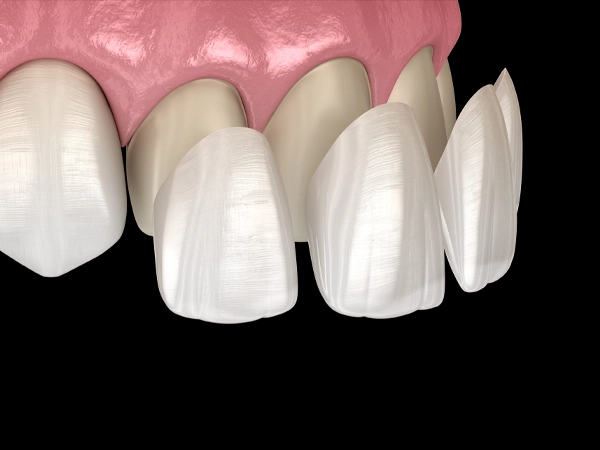 Porcelain veneers for smile enhancement