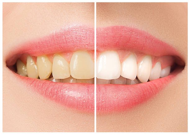 Professional teeth whitening treatment in Pimple Gurav