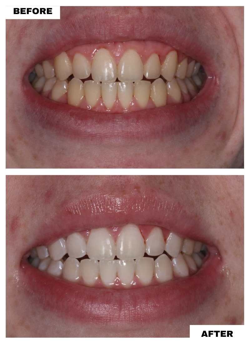 Confident bright smile after whitening in PCMC Pune